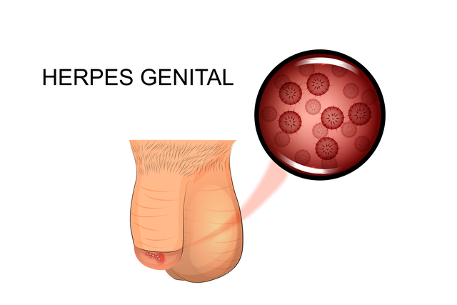 Genital herpes early stage - sexually transmitted diseases caused by the herpes simplex virus (HSV)