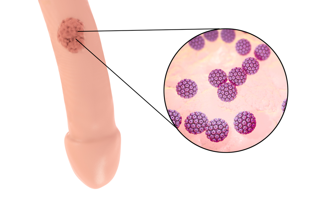 Genital herpes early stage - sexually transmitted diseases caused by the herpes simplex virus (HSV)